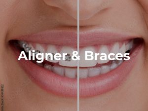 Aligners and Braces