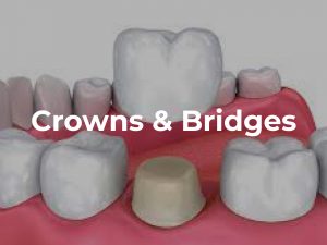 Crowns and Bridges