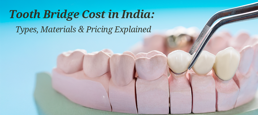 Crowns and Bridges Treatment