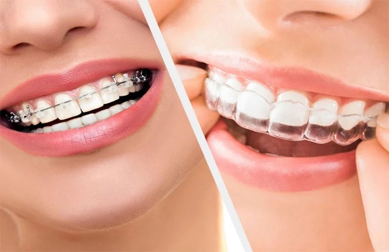 Orthodontic Treatments
