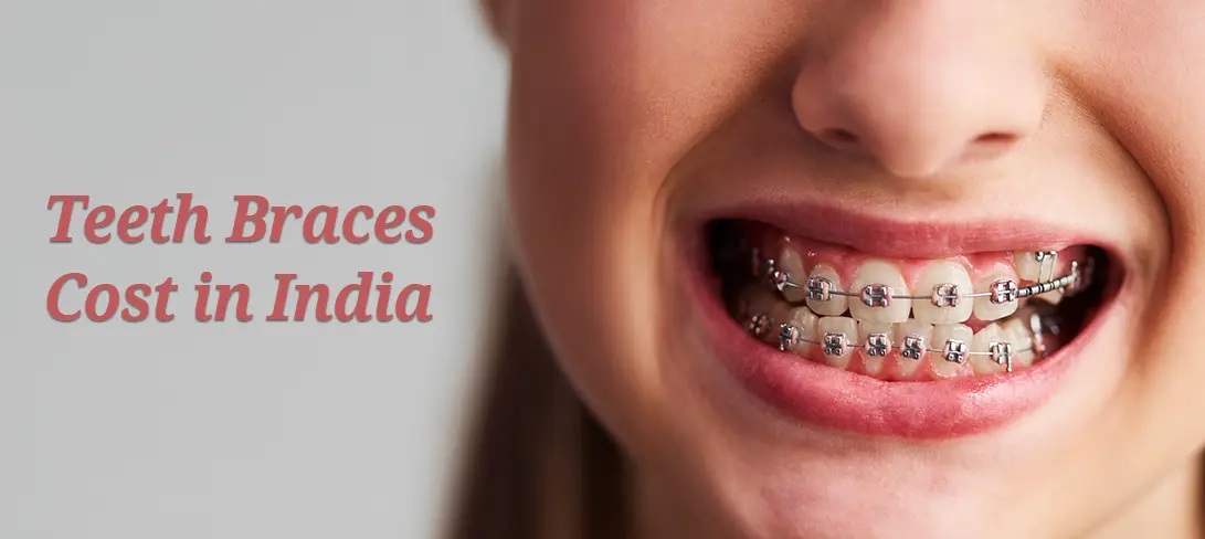 Aligners and Braces